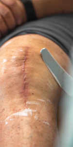 Wound Care Services